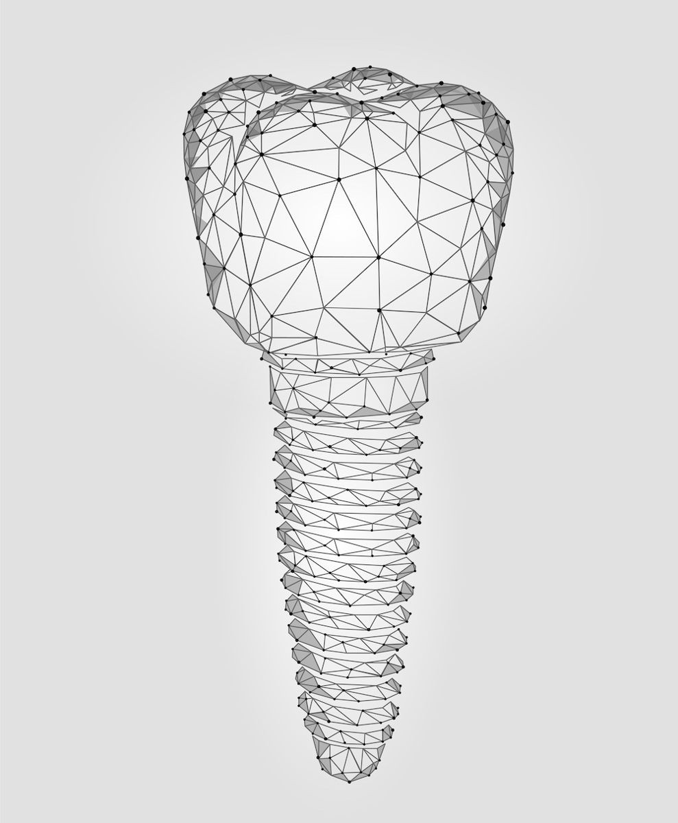 3d graphic art design of a dental implant