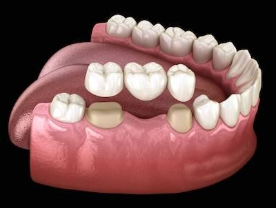 illustration of dental bridge being used to replace teeth in Monroe, WA