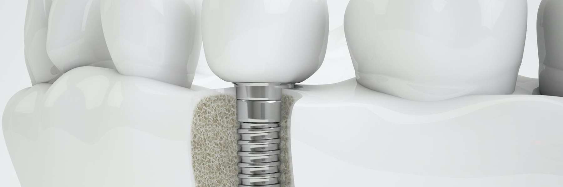 An illustration of a Dental Implant in Monroe, WA