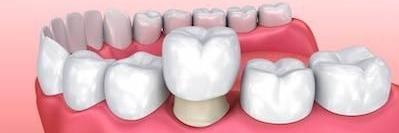 illustration a dental crown